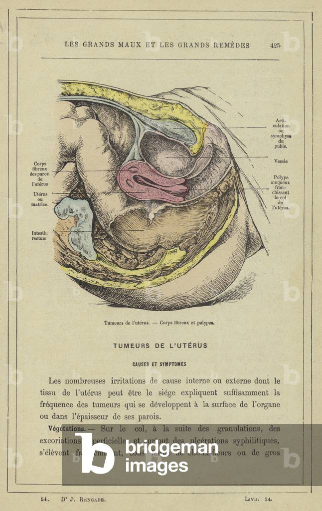 Tumeurs de l'uterus, Corps fibreux et polypes (colour litho)