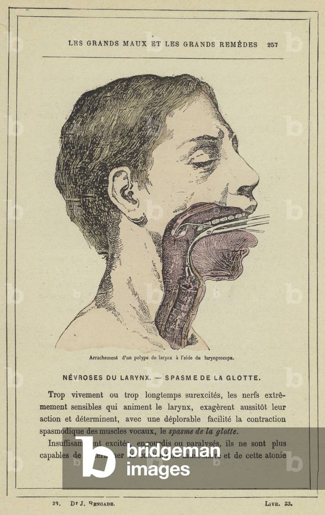 Arrachement d'un polype du larynx a l'aide du laryngoscope (colour litho)