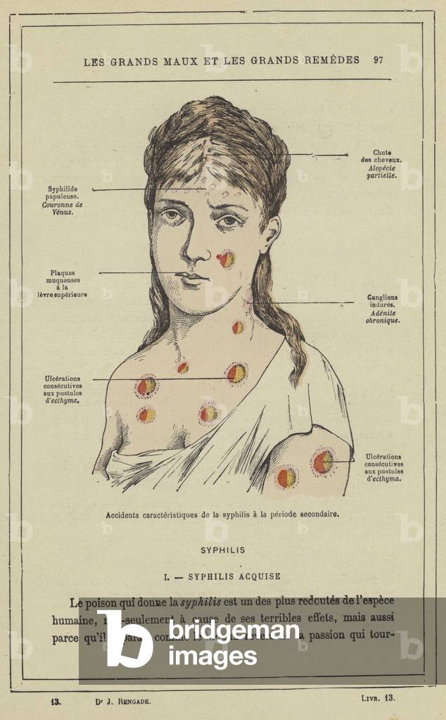 Accidents caracteristiques de la syphilis a la periode secondaire (colour litho)