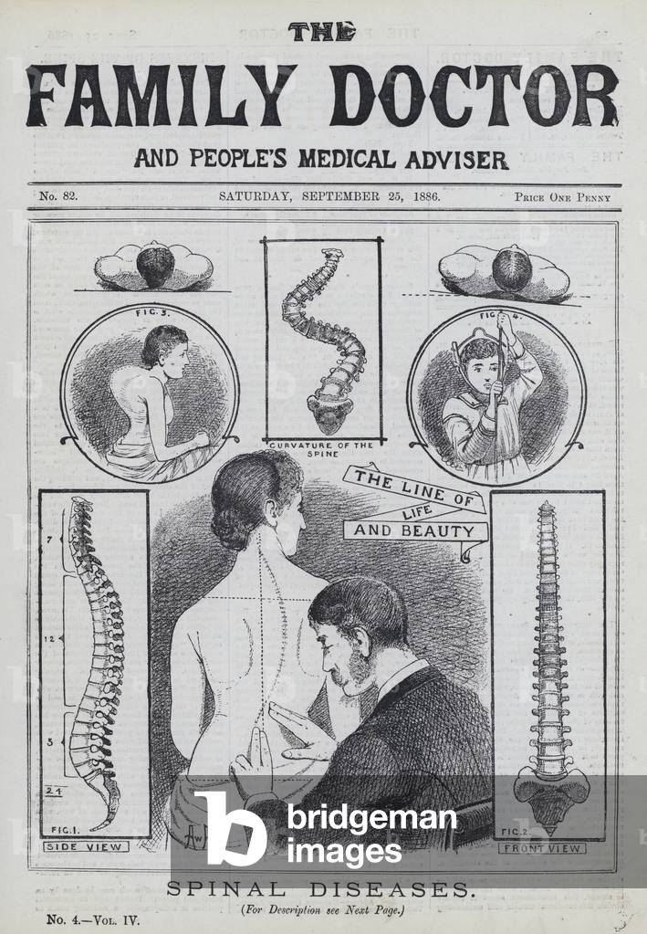 Spinal diseases (engraving)