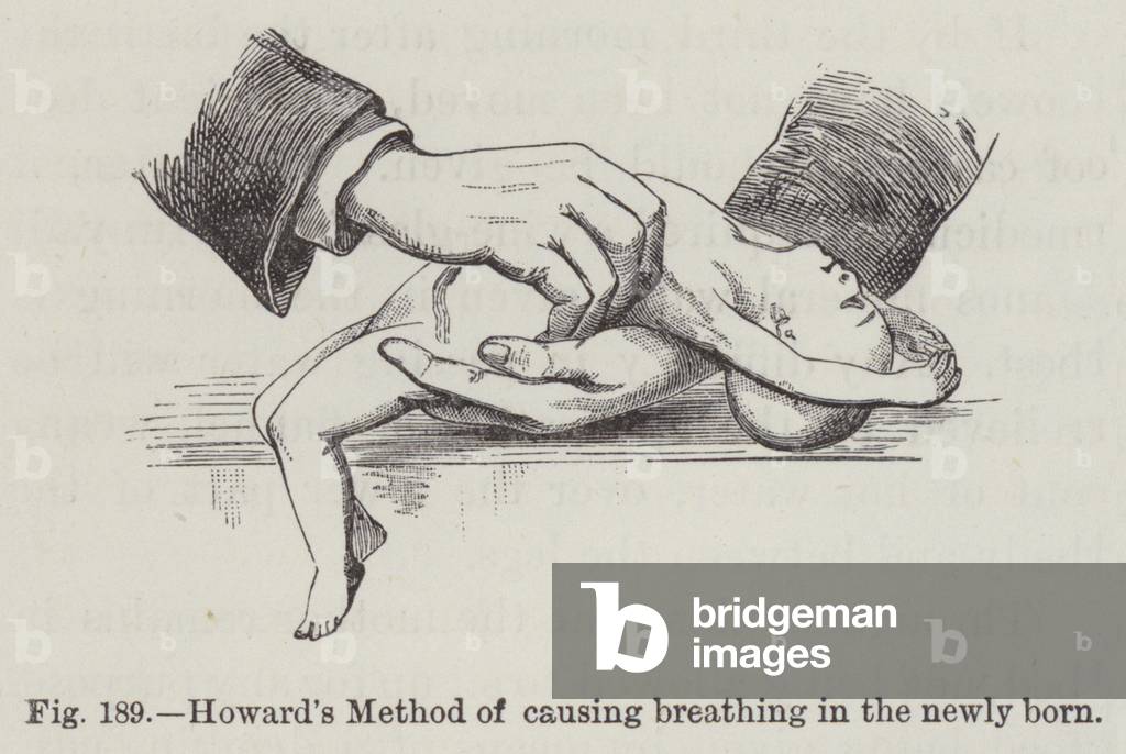 Howard's Method of causing breathing in the newly born (engraving)