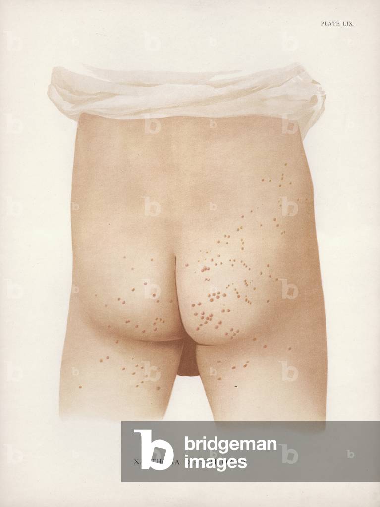 Diseases of the Skin: Xanthoma Diabeticorum (colour litho)