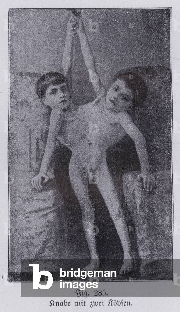 Giacomo and Giovanni Battista Tocci, Italian conjoined twins (b/w photo)
