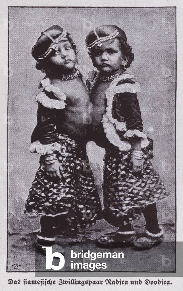 Radica and Doodica, Indian conjoined twins (b/w photo)