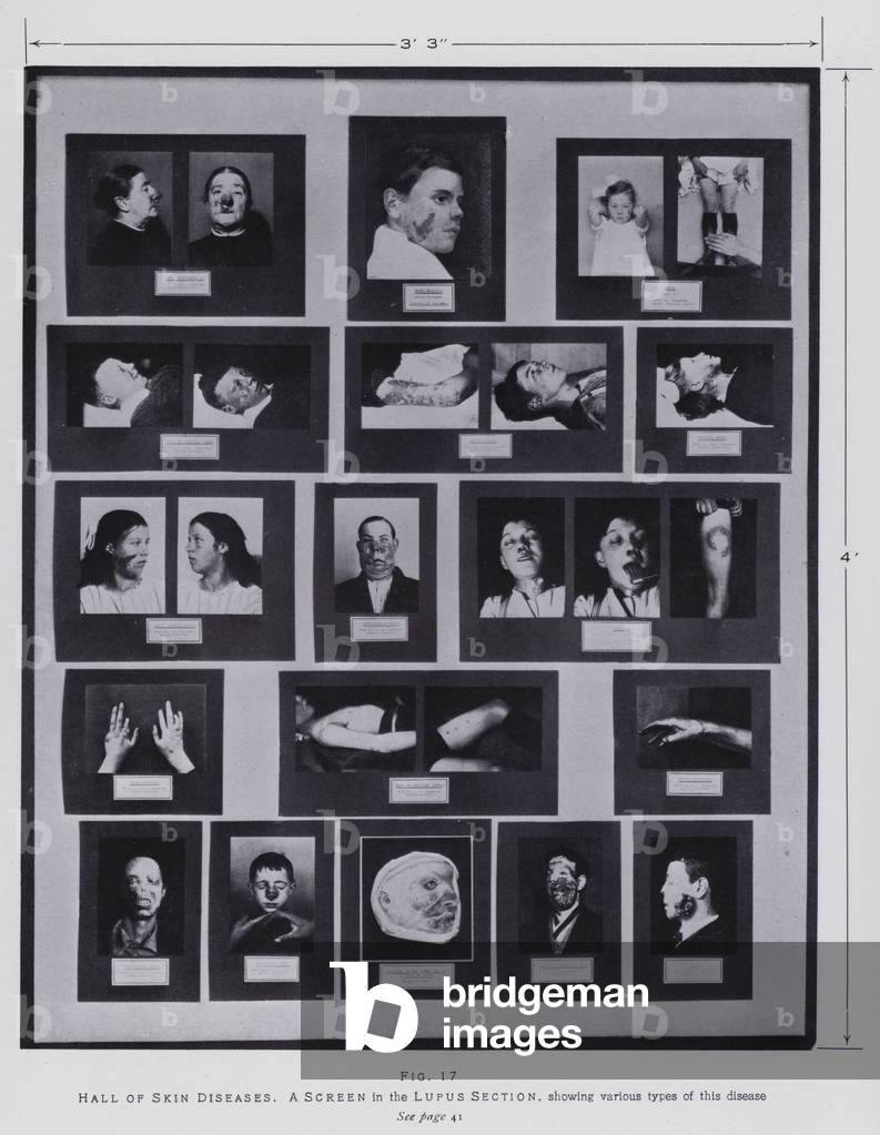 Wellcome Museum: Hall of Skin Diseases, Screen, Lupus Section (b/w photo)