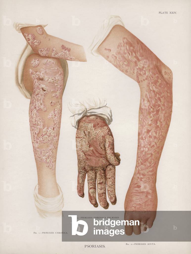 Diseases of the Skin: Psoriasis (colour litho)