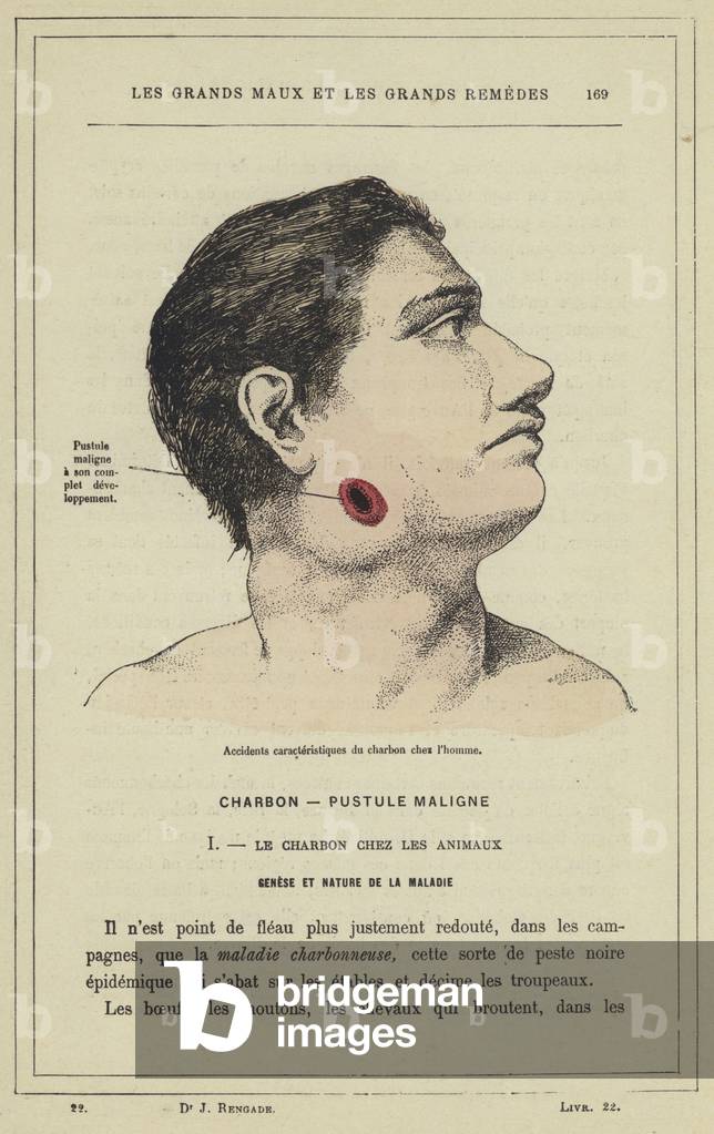 Accidents caracteristiques du charbon chez l'homme (colour litho)