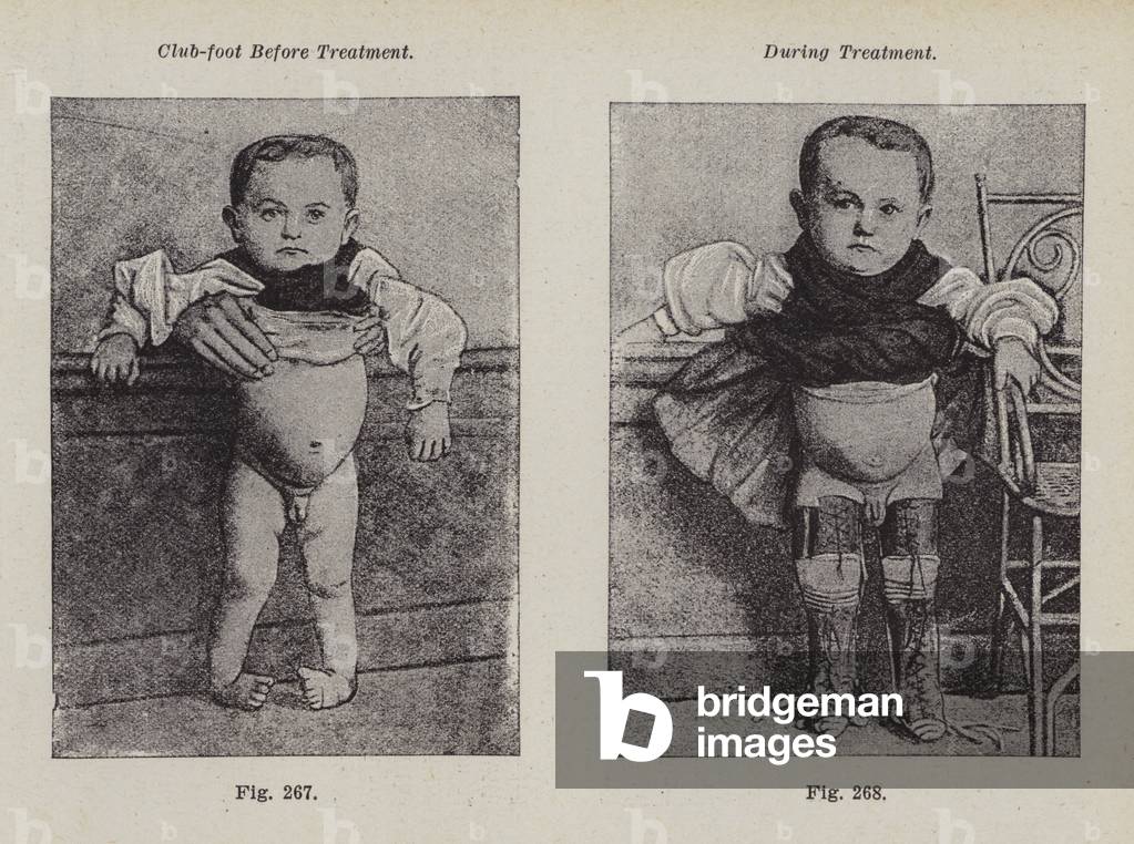 Club-foot before treatment; During treatment (b/w photo)