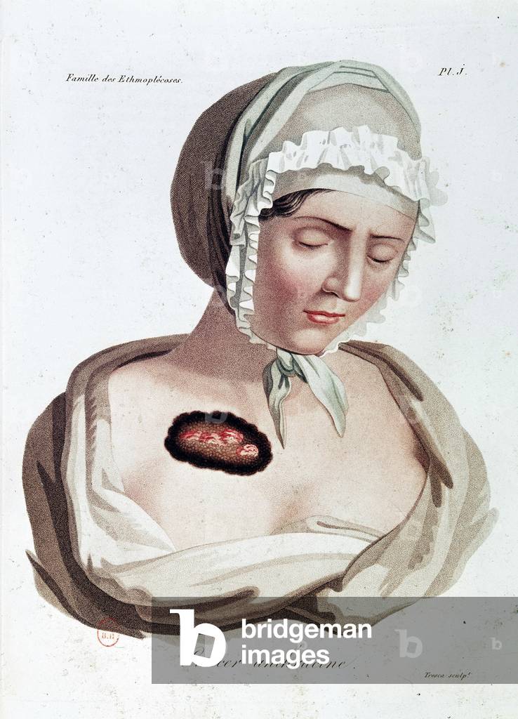 Anthracine Cancer - Alibert, B.N.