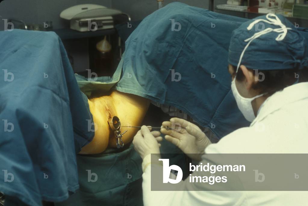 Artificial insemination