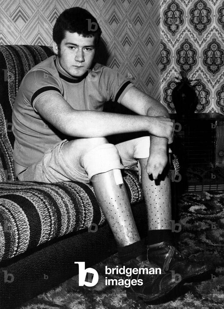 Medical - Thalidomide: Still waiting. Brian Huckstepp. He was twice declared a thalidomide child by a surgeon who wrote he had 