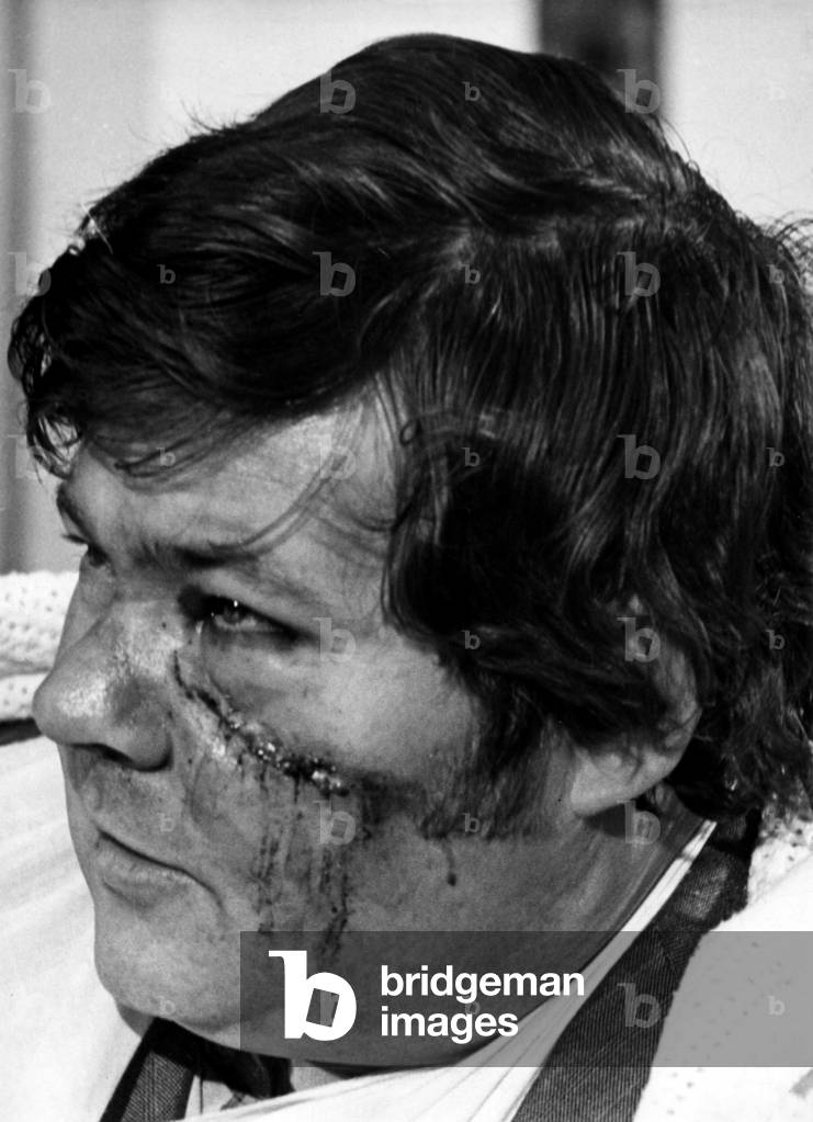 Findlay Guild one of the three passengers who survived the Piper Cherokee aircraft crash on the 2,348 ft. Hedgehope Hill and were airlifted to hospital in a RAF Sea King helicopter. They were flying from Edinburgh to Sunderland 14/02/1979 (b/w photo)