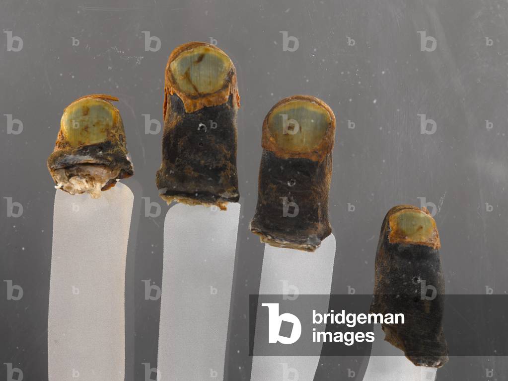 Frostbitten finger tips of Major Michael Bronco Lane, 1976 (human remains)
