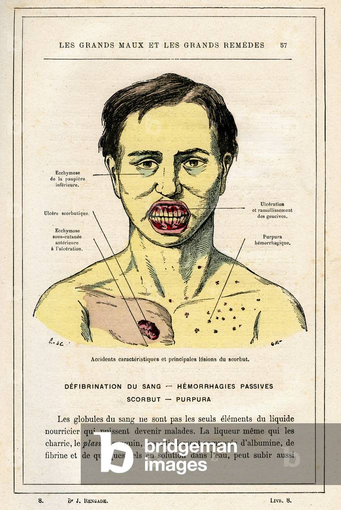 Figure of the book “Les grands maux et les grands remedes”, book of popular medicine by Dr. Jules Rengade, edition of 1889. Face of a sick person with scurvy (purpura).