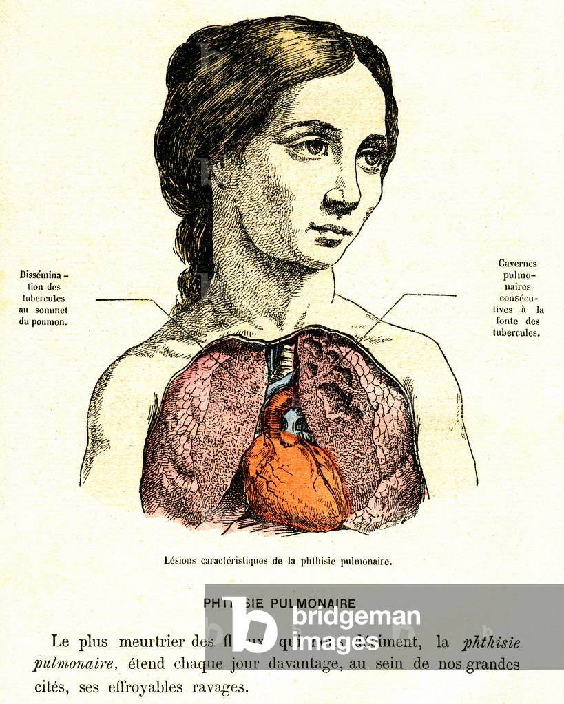 Lung disease. Characteristic effects of pulmonary phtisia in a young woman, 1889 (engraving)