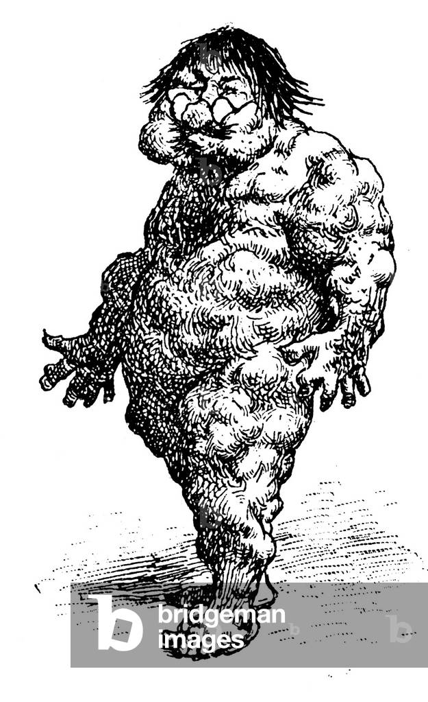 Illustration by Edouard Francois ZIER (1856-1924) for Paul Scarron's “comic novel”: chapter 16 of Part 2 - Ragotin, the body all swells after being stung by bees -