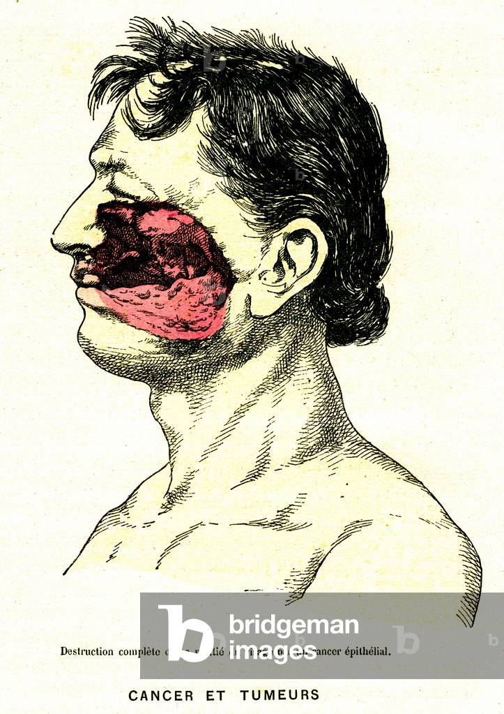 Epithelical cancer of the face (jaw). Engraving from “” Les Grands Ales et les Grands Remedes”” by Jules Rengade, 1889. From “The Principal Illnesses and Their Remedies” by Jules Rengade. (Paris, 1889).