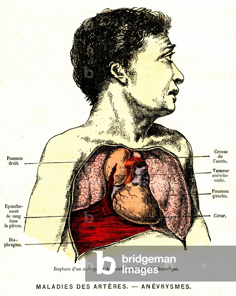 Disease of arteres - rupture of aneurysm from 