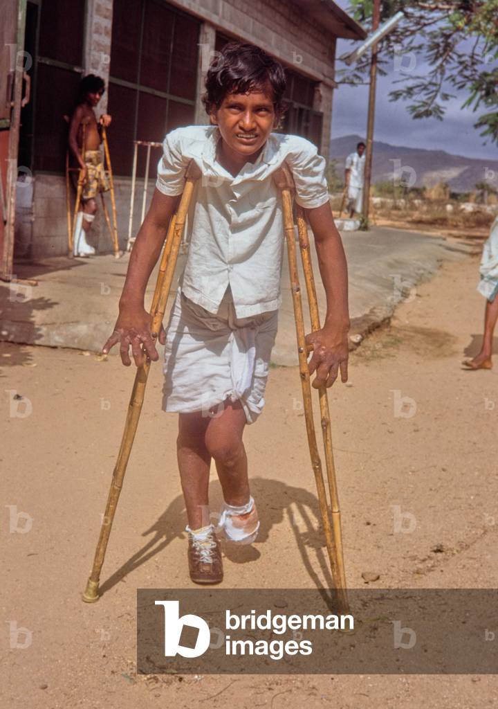 Leprosy patient at CMC Hospital, Vellore, Tamil Nadu, South India (photo)