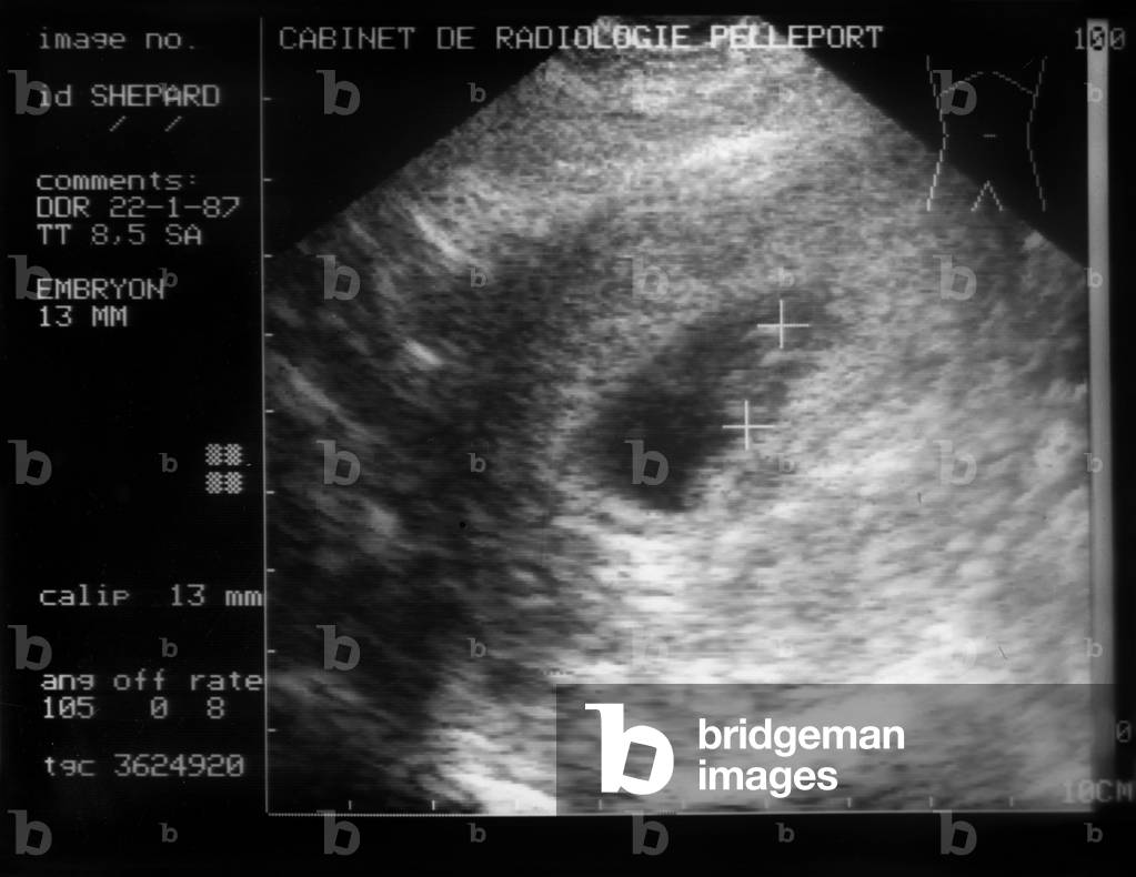 Ultrasound, 1987 (photo)