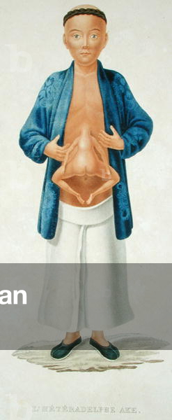 Chinese man with an undeveloped conjoined twin attached to his abdomen, illustration from a French travel book, engraved by M. Legrand (coloured engraving)