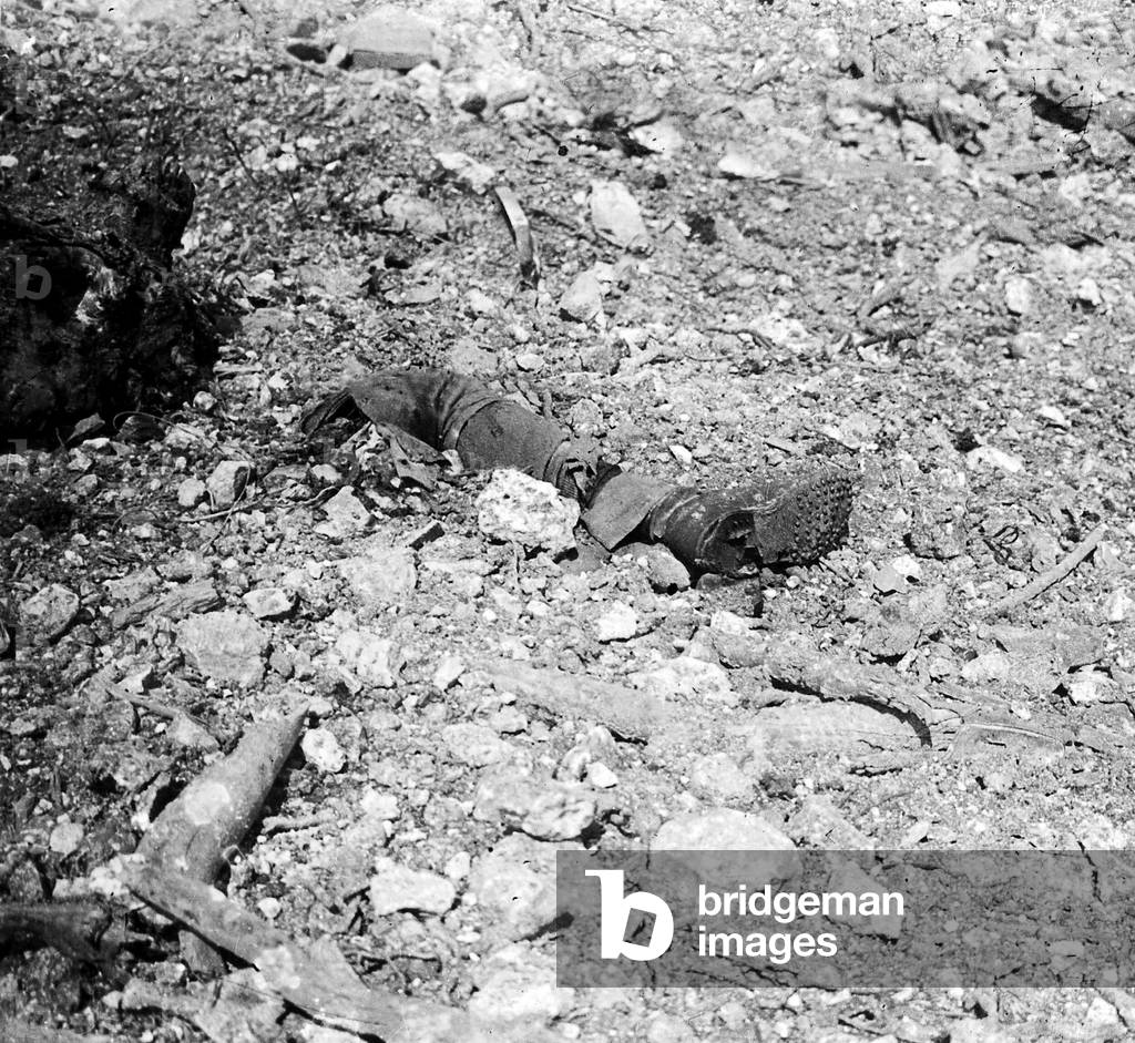 Torn leg of soldier in Verdun during the war 1916