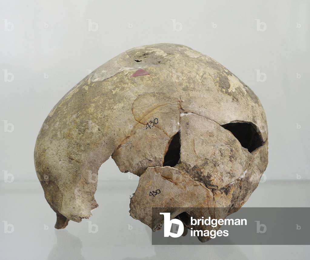 Human skull with marked trace of the blow with a blunt instrument, prehistory