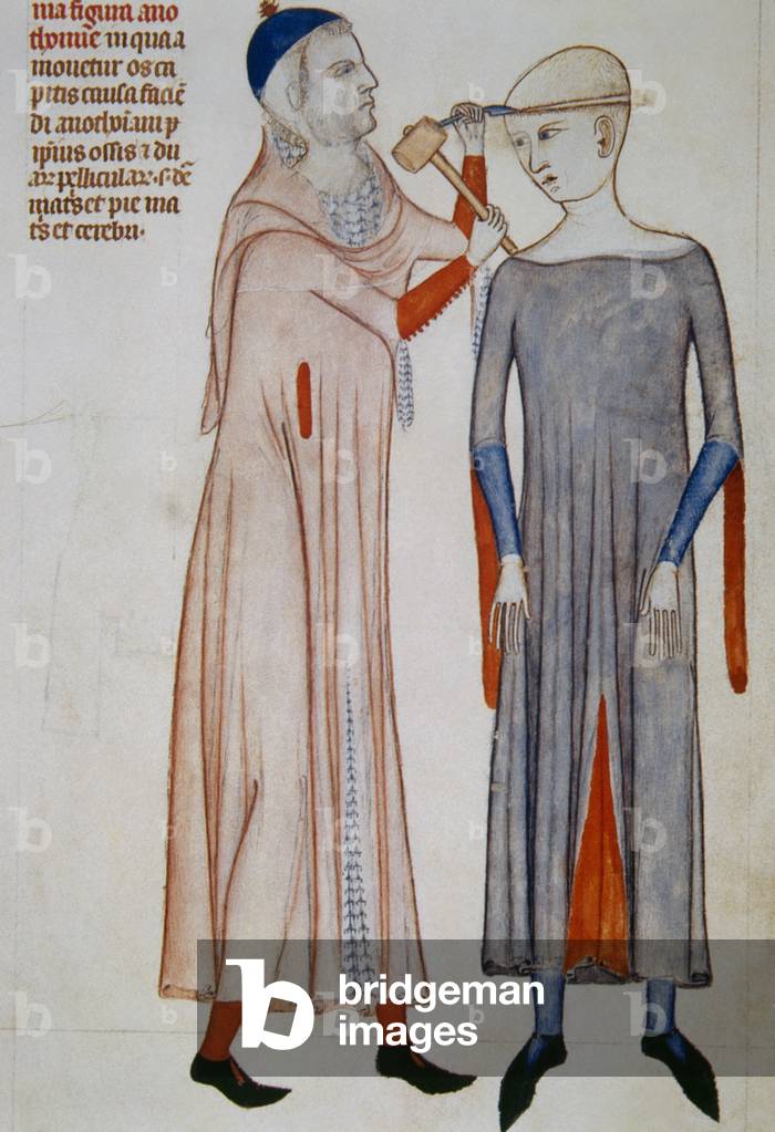 Trepanation. Miniature. 14th c. Treatise on anatomy by Mondino de Liuzzi (1270-1326).