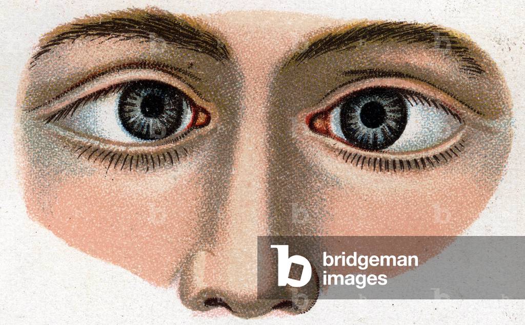 Strabismus converge. “The new natural medication” by F.E. Bilz.