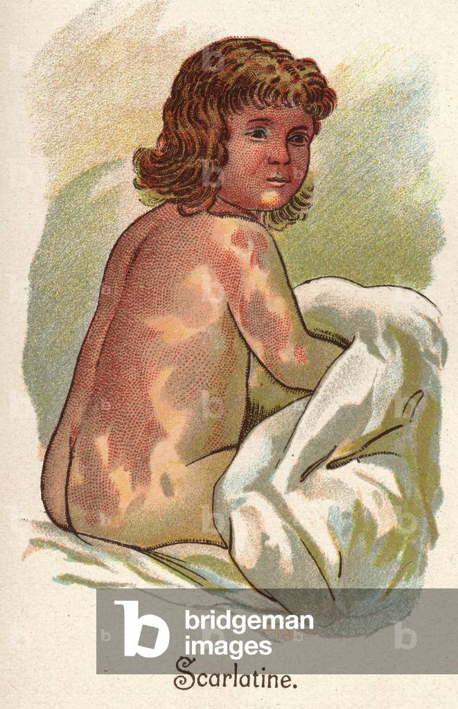 Children's diseases: Scarlet fever. In” The new natural medication”” by F.E. Bilz.