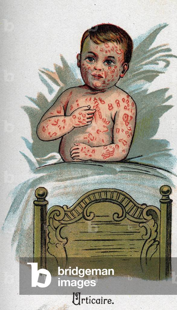 Children's diseases: Hives. In” The new natural medicine”” by F.E. Bilz.