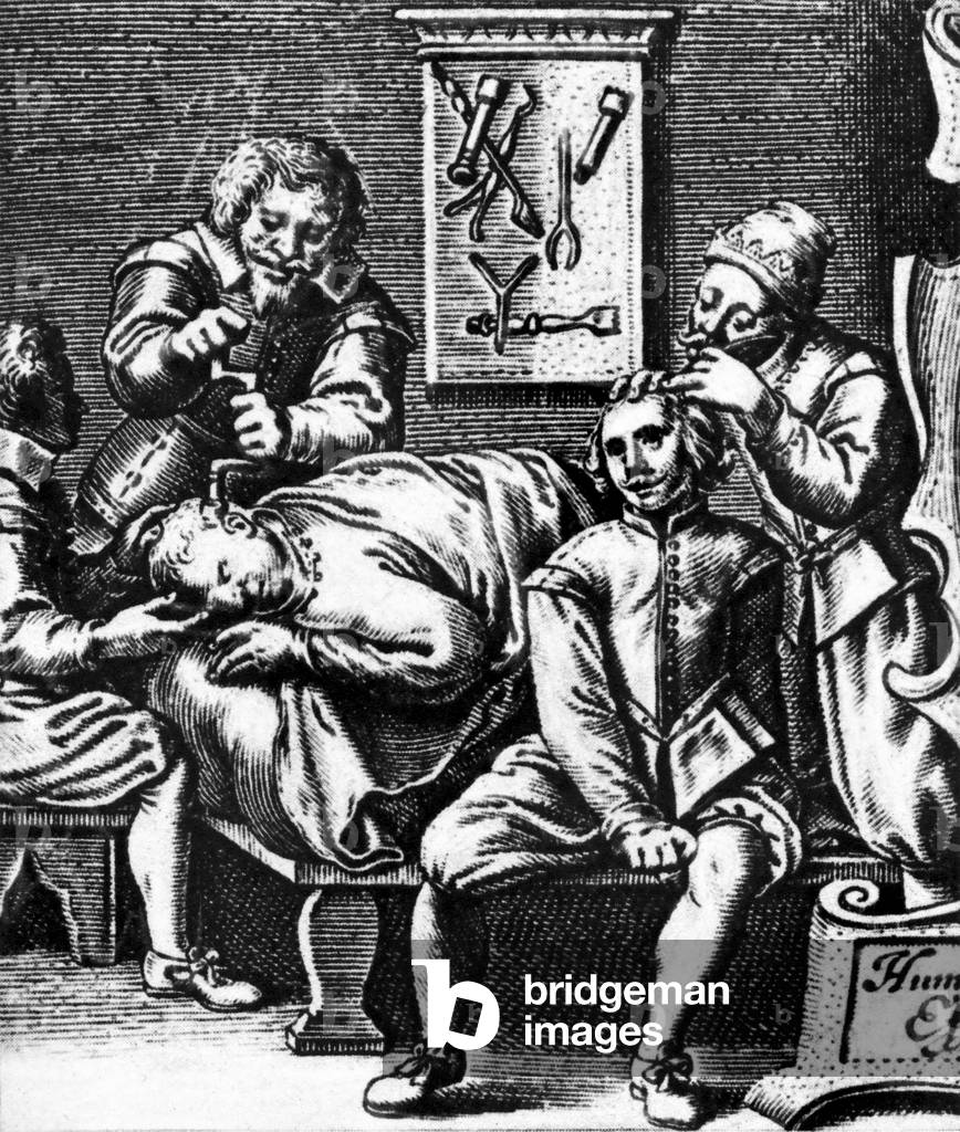 Medical Operation in the 17th century