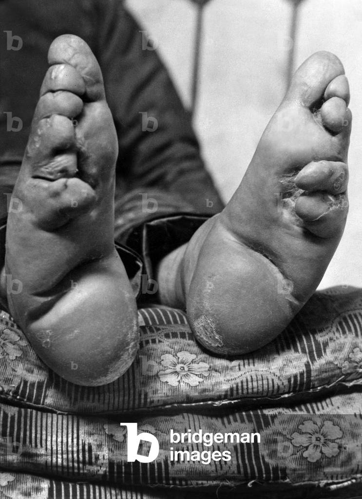 A 'lily footed' woman of China (Foot binding), c. 1949