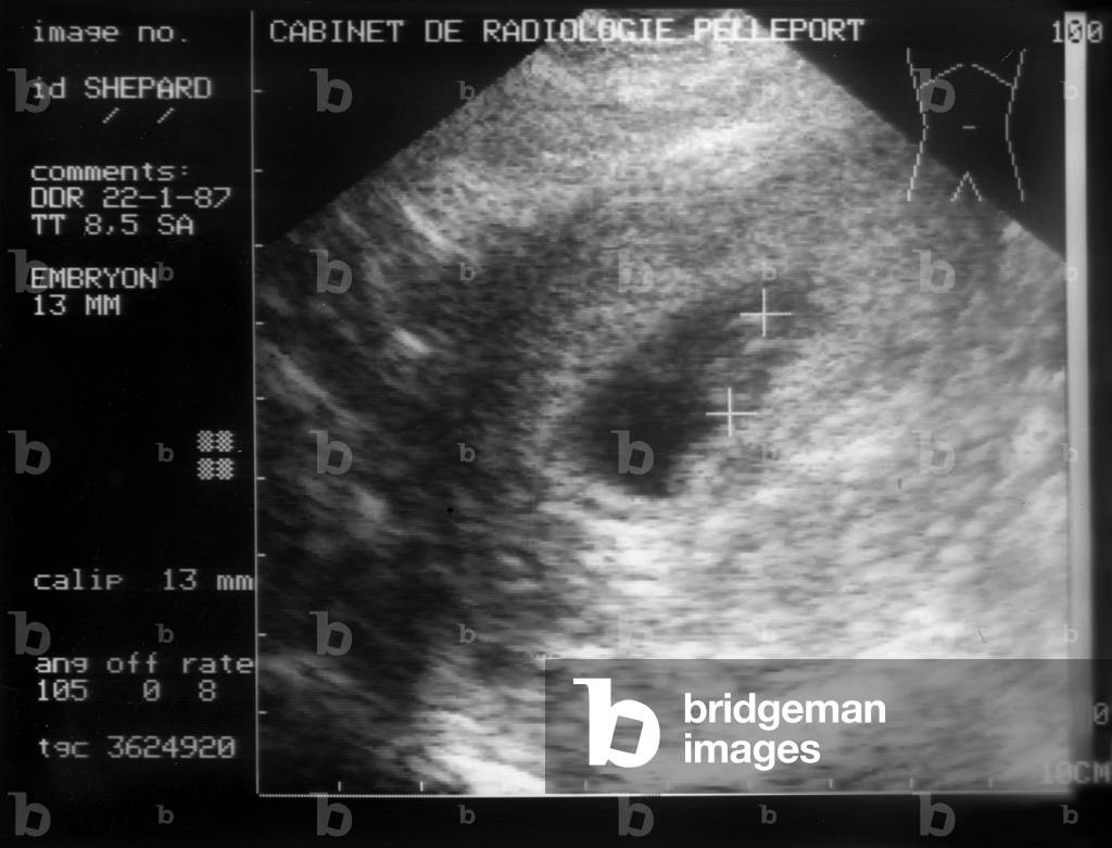 ultrasound of uterus showing a 8, 5 weeks embryo, January 22, 1987