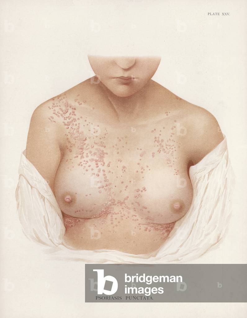 Diseases of the Skin: Psoriasis Punctata (colour litho) by English Artist