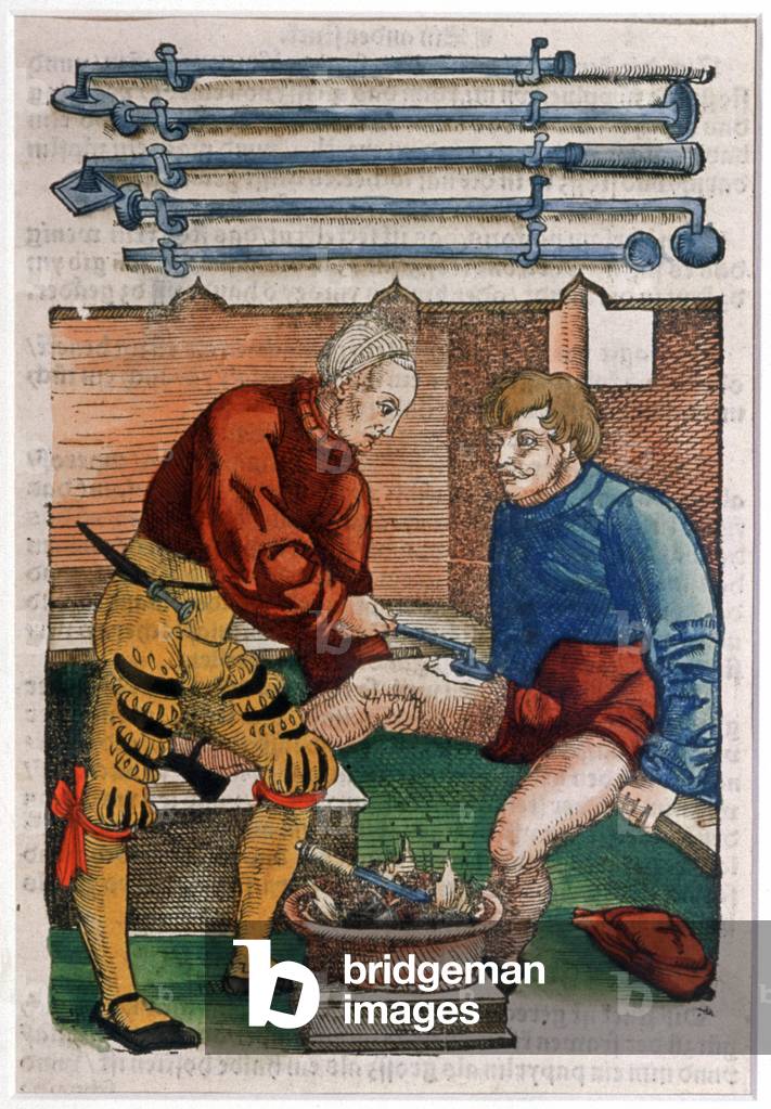 Cauterizzazione, 1540 circa (xilografia colorata)