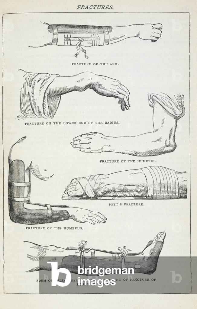 Frakturen und Methoden der Bandagierung.