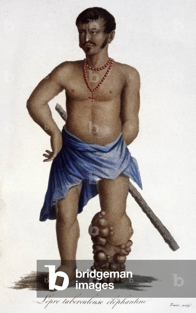 Bild von Gravur "Elephantiasis" 1832