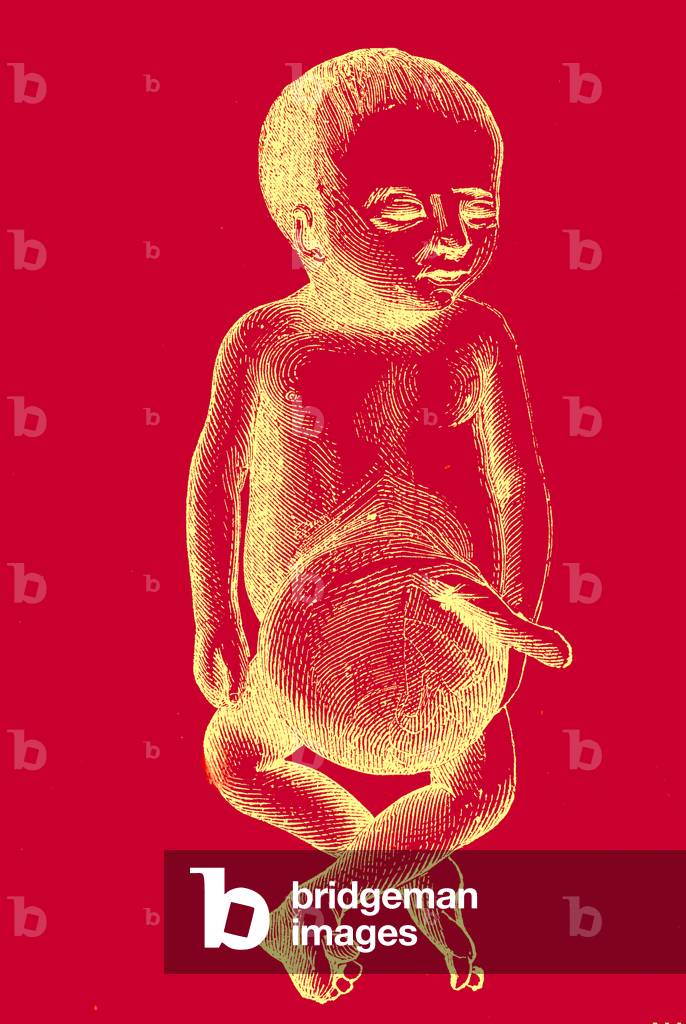 Foetus masculin à terme. Hernie ombilicale, 1877 (gravure)