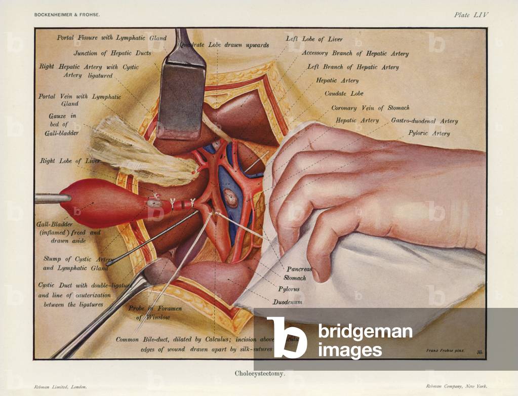 Immagine di Stampa "Colecistectomia (litografia a colori)" 1901 di Franz Frohse