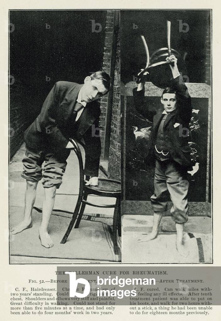 Immagine di Stampa "La cura Tallerman per i reumatismi (foto b/n)" di English Photographer