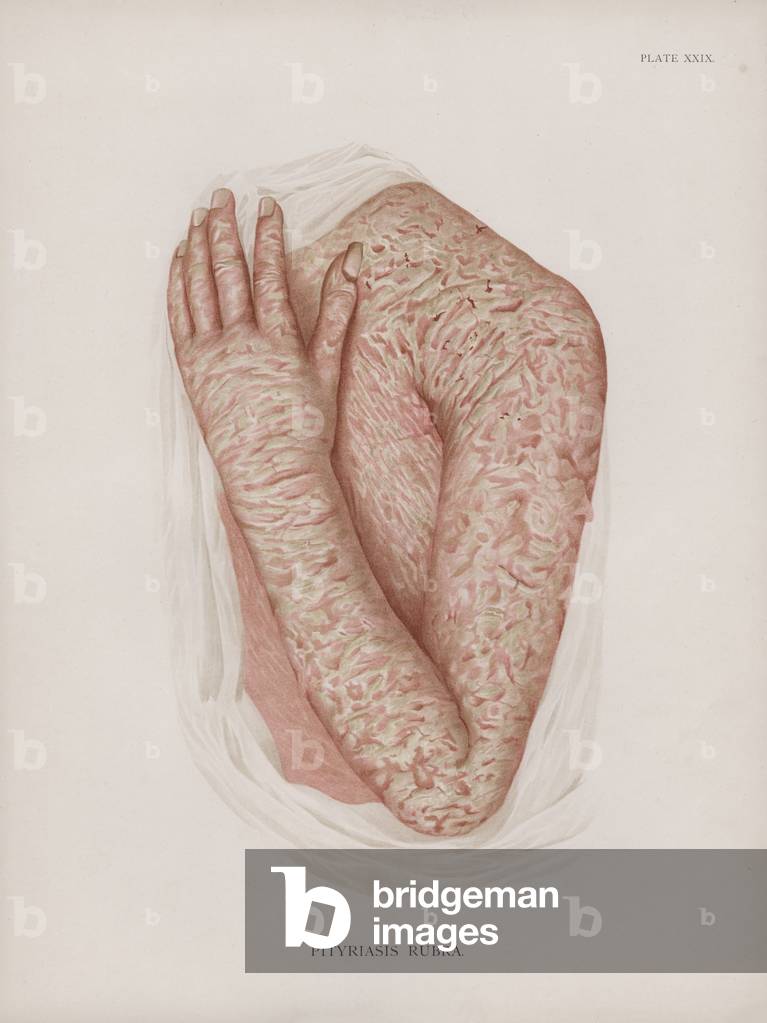 Diseases of the Skin: Pityriasis Rubra (colour litho) by English Artist
